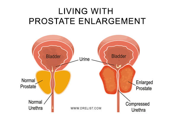 Living with Prostate Enlargement