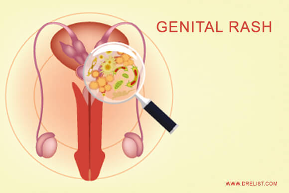 Genital Rash | Possible Reasons