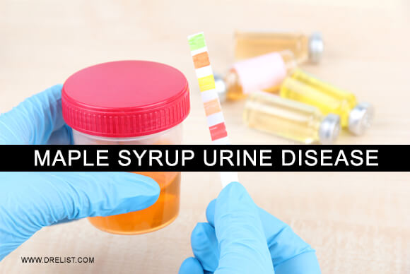 Maple Syrup Urine Disease