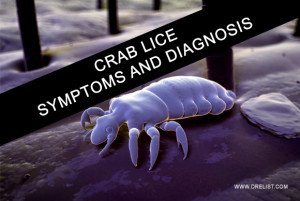 Crab Lice Symptoms And Diagnosis image