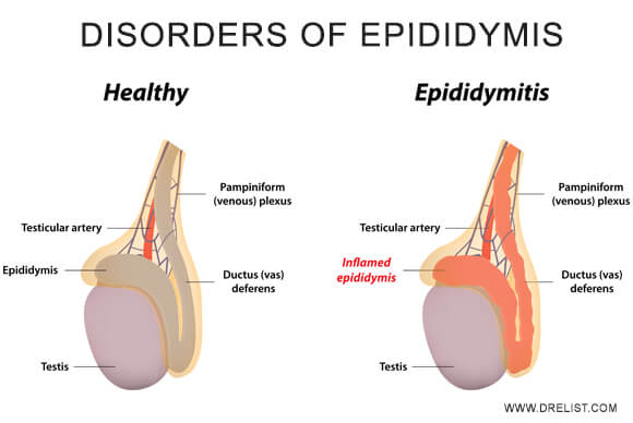 Disorders Of Epididymis