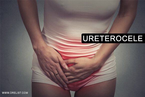 Ureterocele