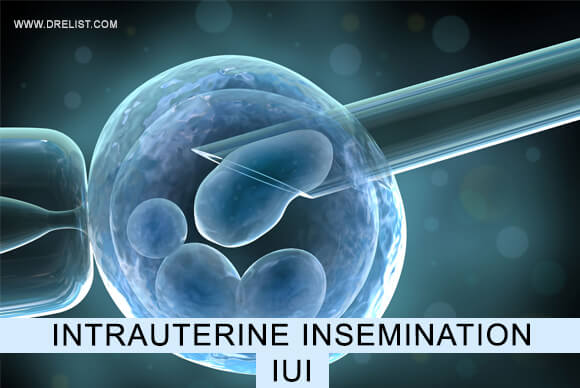Intrauterine Insemination (IUI)