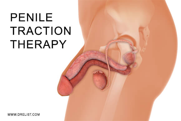 Penile Traction Therapy
