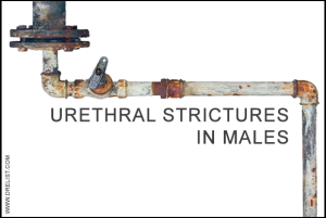 Urethral Strictures in Males image