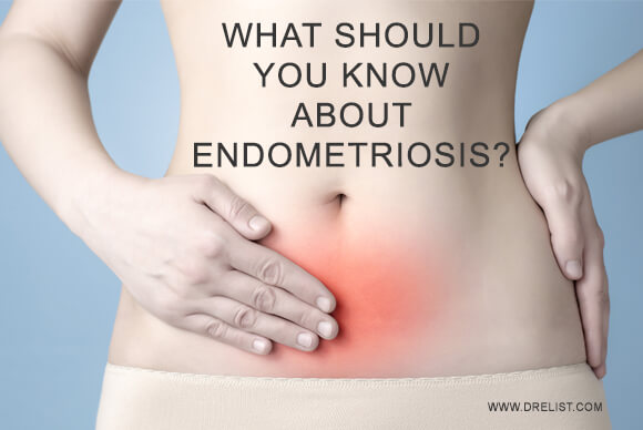 What Should You Know About Endometriosis?