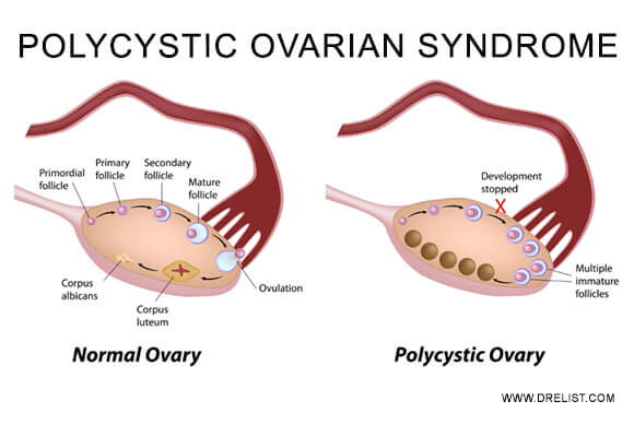 Polycystic Ovarian Syndrome