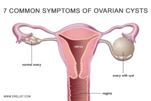 7 Common Symptoms Of Ovarian Cysts Image
