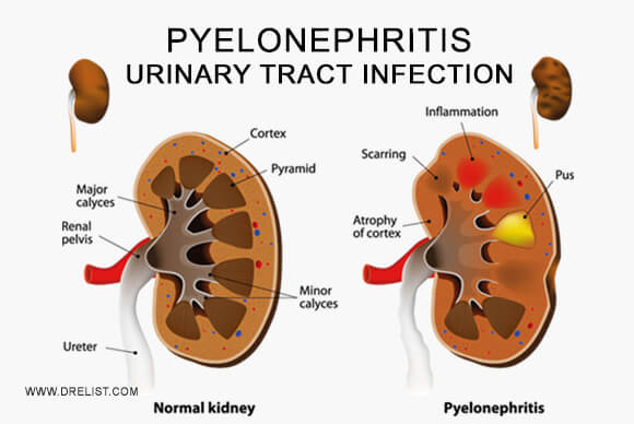 Pyelonephritis - Urinary Tract Infection