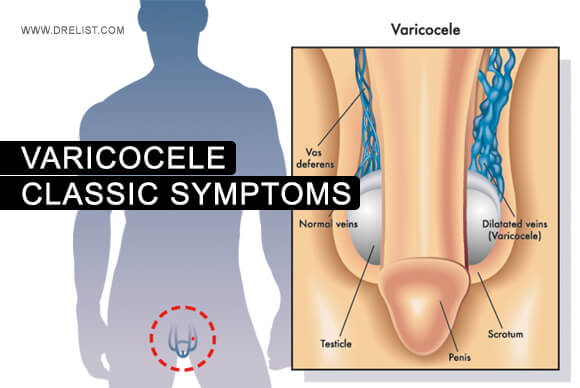 Varicocele | Classic Symptoms