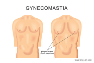 Gynecomastia image