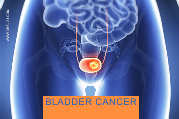 Bladder Cancer