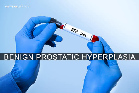 Benign Prostatic Hyperplasia