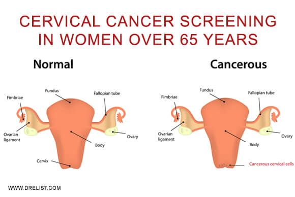 Cervical Cancer Screening In Women Over 65 Years