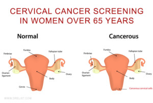Cervical Cancer Screening In Women Over 65 Years Image