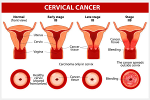 HPV vaccince image