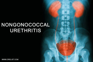 Nongonococcal Urethritis Image