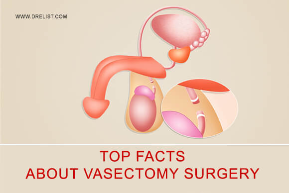 Top Facts About Vasectomy Surgery