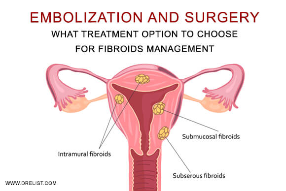 Embolization And Surgery – What Treatment Option To Choose For Fibroids Management
