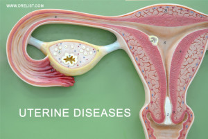 Uterine Diseases image