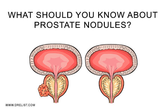 What Should You Know About Prostate Nodules?
