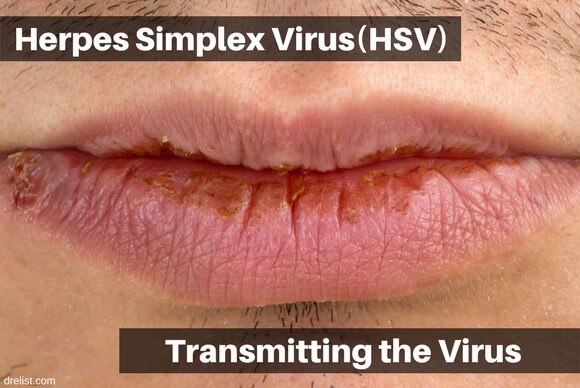 Herpes Simplex Virus(HSV) - Transmissions Of The Virus