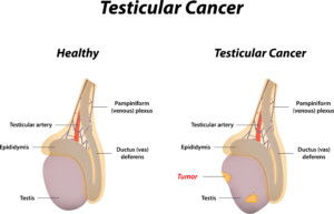  testicular cancer example