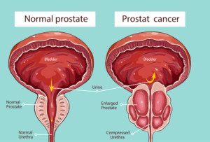 prostatic hypertrophy
