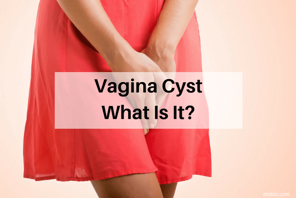 Vaginal Cysts