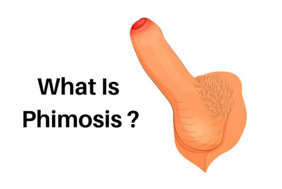 What is Phimosis?