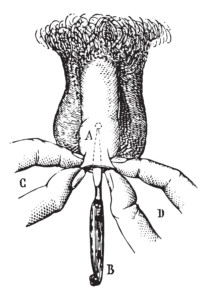 Phimosis  Operation