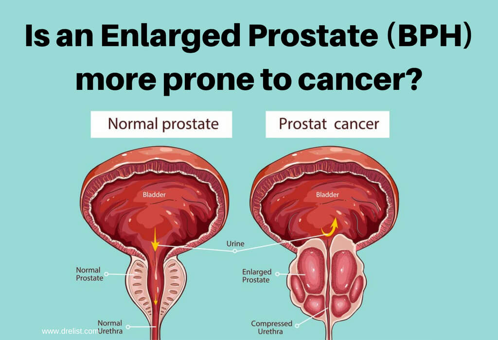 Is an Enlarged Prostate (BPH) more prone to cancer?