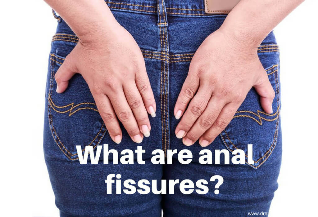What are anal fissures?
