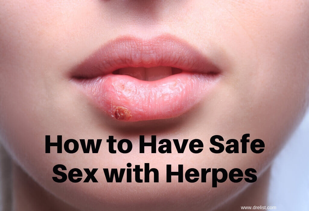 How to Have Safe Sex with Herpes
