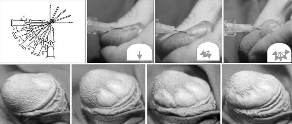 Hyaluronic Acid (HA) for Penile Girth Enlargement and Enhancement
