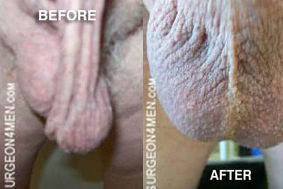 Before And After