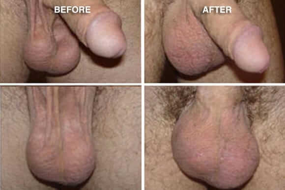 Before And After