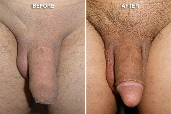 Repair of Incomplete Circumcision