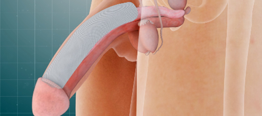 Penile Implant