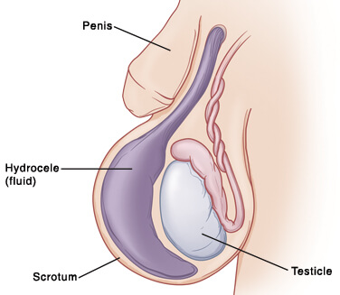hydrocele repair surgery