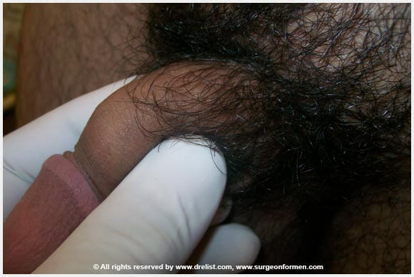 Random Alloderm Cases