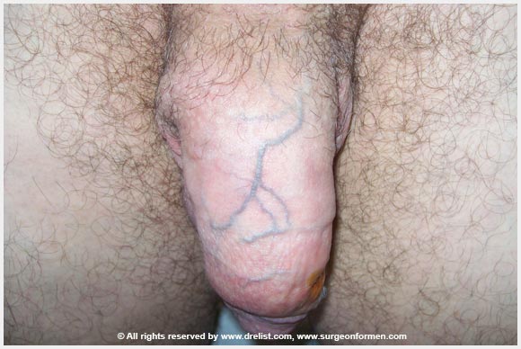 Random Alloderm Cases