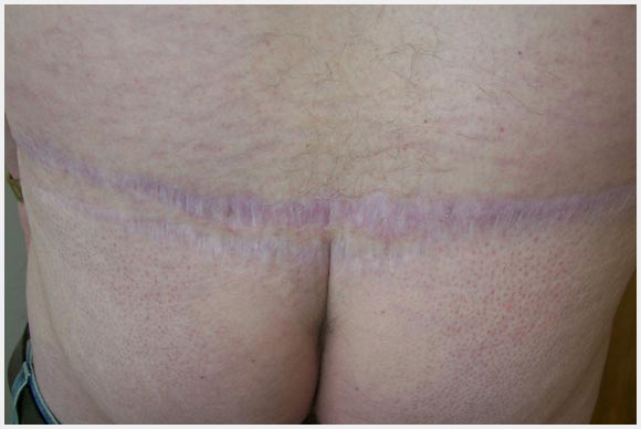 Dermal Graft Aka Dermal Fat Grafts Come From