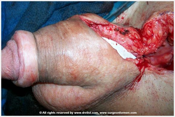CASE #1: (DFG) Severe Infection, Removal, And Penis Reconstruction Surgery