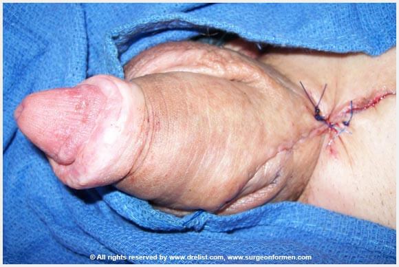 CASE #1: (DFG) Severe Infection, Removal, And Penis Reconstruction Surgery