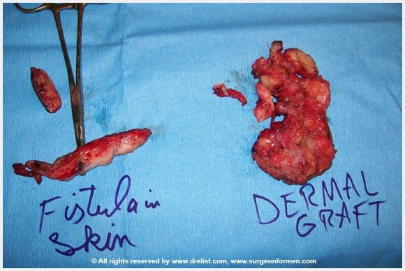 CASE #2: (DFG) Severe Infection, Removal, and Penis Reconstruction Surgery