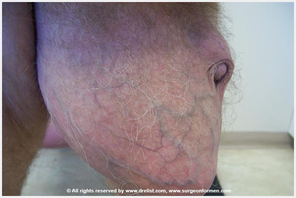 Patient With Scrotum PMMA Injections
