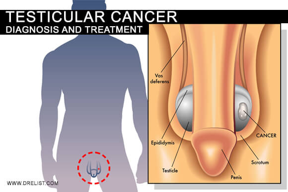 Testicular Cancer – Diagnosis and Treatment