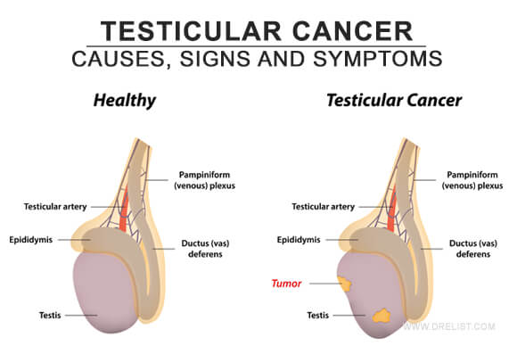 Testicular Cancer – Causes, Signs and Symptoms