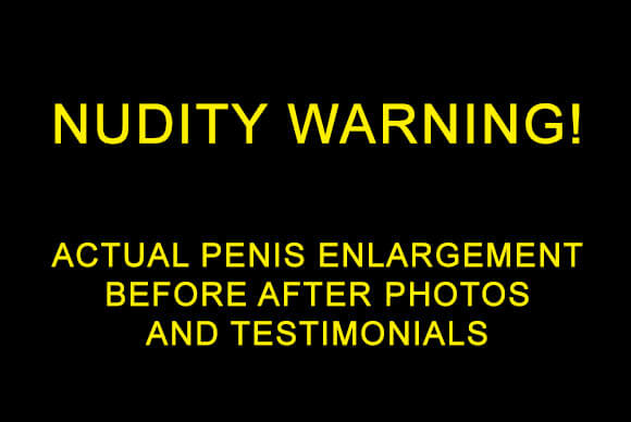 Penis Enlargement Before and After Photos with Actual Patients